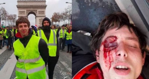 “Je m’appelle Franck, j’ai 20 ans et j’ai été défiguré par les forces de l’ordre”. Appel à soutien