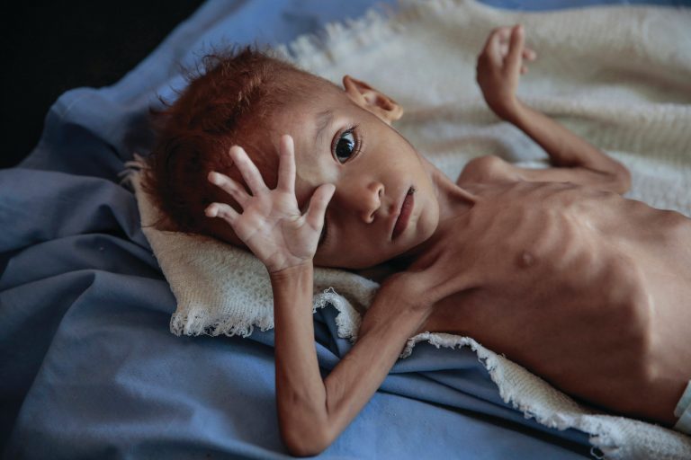Yemen: in a country stalked by disease, Covid barely registers
