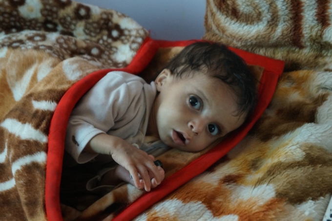 Yemen: A child under the age of five dies every 10 minutes of preventable causes