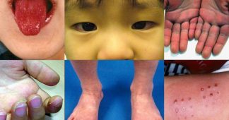 Kawasaki-like disease afflicting young children and teens after infection with SARS-CoV-2
