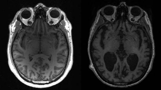Bizarre neurological illness plagues young Canadians
