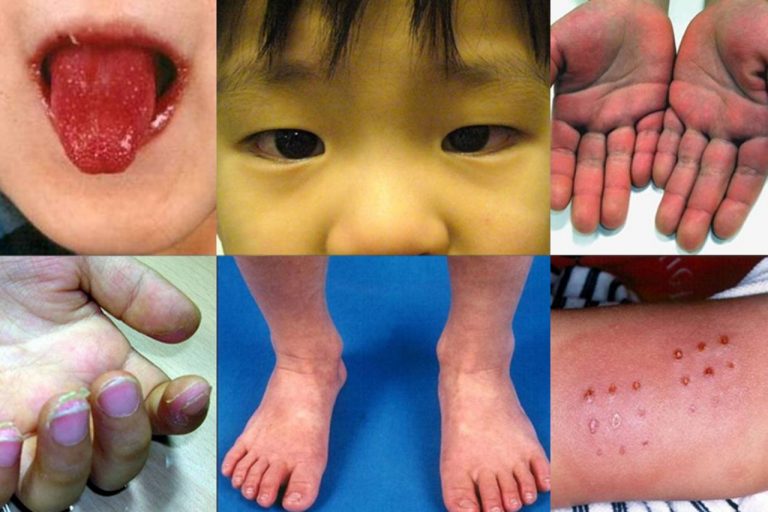 Kawasaki-like disease afflicting young children and teens after infection with SARS-CoV-2