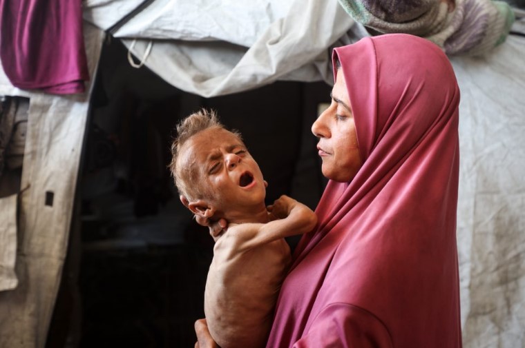 Israeli Doctors Say Gaza Children Are Starving Due to Israel’s Blockade, Not Because of Pre-Existing Medical Conditions