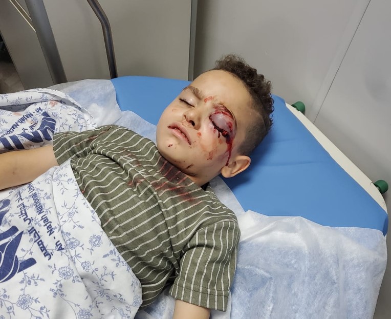 Israeli forces blind 3 Palestinian children with live ammunition, stun grenade