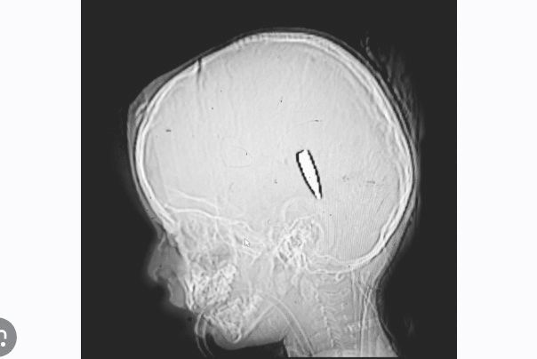 Gunshot wounds in Palestinian children indicate targeted fire